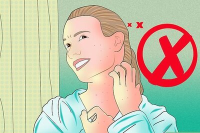 How to Relieve Itching from Chickenpox