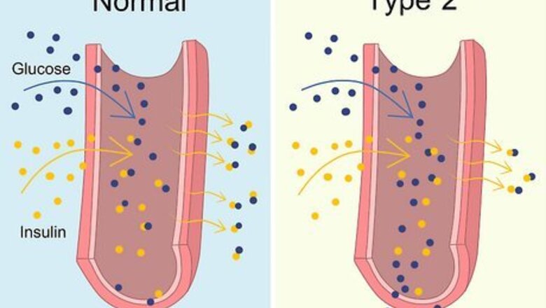 How to Treat Type 2 Diabetes
