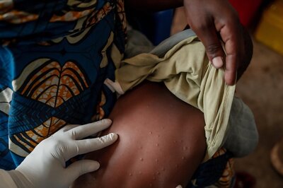 WHO Grants First Mpox Vaccine Approval Amid Surging Cases In Africa