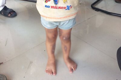 Mother Hits Child With Hot Spoon For Bowel Incontinence