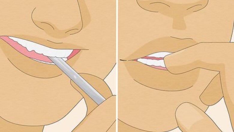 How to Fix an Overbite