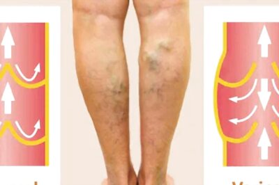 What Are Varicose Veins? Know Causes, Symptoms And Treatment