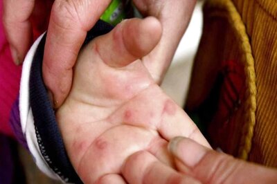 Tomato Fever: Experts Warn of 'Serious Consequences' If 'Very Contagious' Virus Spreads. Know Symptoms, Cure