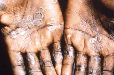 Detect, Treat, Defeat: Centre on Alert, Issues Fresh Guidelines as World Sees Over 300 Monkeypox Cases