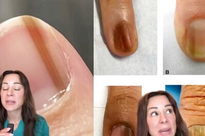 Dermatologist Reveals Dark Vertical Line On Your Nails Could Be Cancer