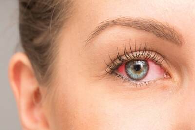 6 Home Remedies To Get Rid Of Bloodshot Eyes