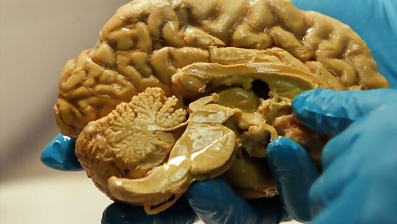 'Brain-eating amoeba' kills 10 people in Pakistan