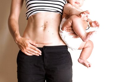 Busting 8 Myths And Misconceptions About C-Section