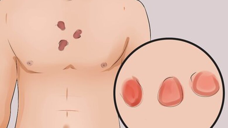 How to Tell the Difference Between Eczema and Psoriasis