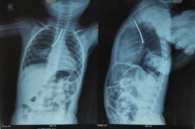 West Bengal Doctors Take Out Nail From 2-Year-Old’s Throat in Hours-Long Operation