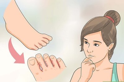 How to Treat Athlete's Foot