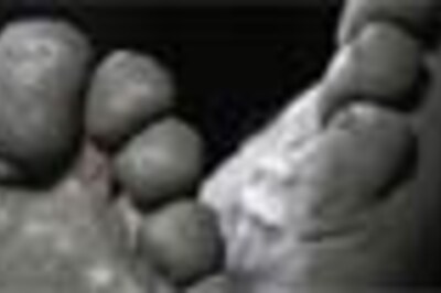 A case of smelly feet