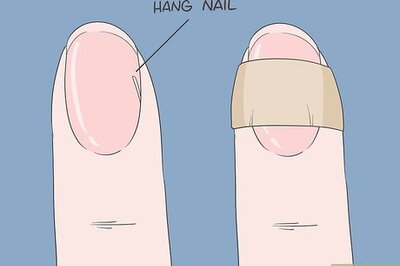 How to Heal Hangnails Fast