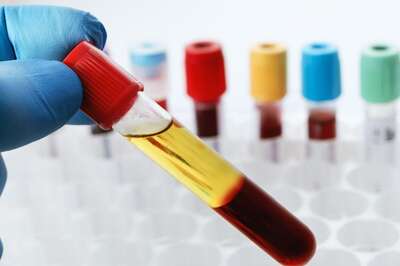 What Is Platelet-Rich Plasma Therapy And How Does It Work?