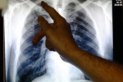 India's Draft Strategy to Eliminate TB Seems More Smoke Than Fire