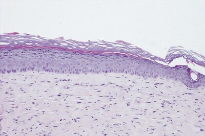 Stem-cell therapy wipes out HIV in two patients: Report