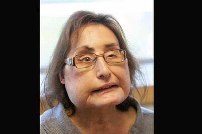Ohio face transplant patient meets donor's family