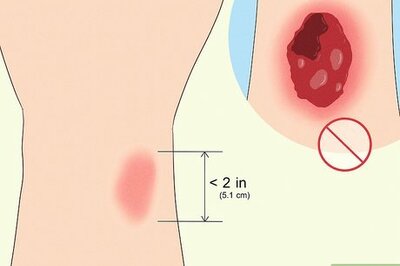 How to Treat a Burn Using Honey