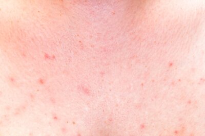 What leads to Breast Acne? Check Out the 8 Most Prominent Factors