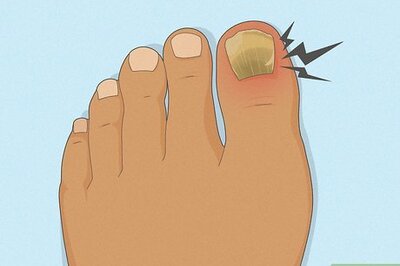 Getting Rid of Toe Fungus: The Complete Guide