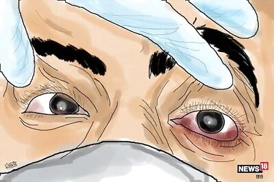 Jharkhand Records 3 More Black Fungus Deaths, Toll Reaches 29