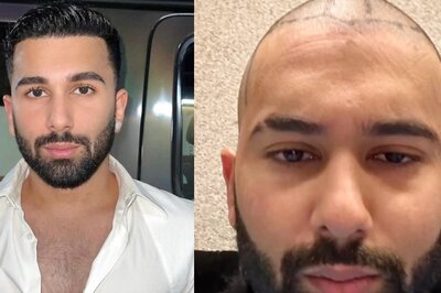 How Orhan Awatramani Broke Stereotypes Around Getting A Hair Transplant In Your Early 20s