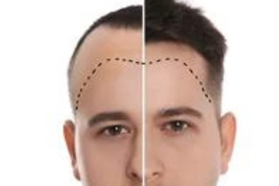 What Is A Hair Transplant? Debunking 5 Myths About It