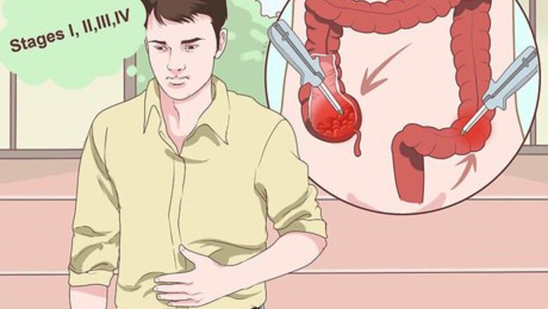 How to Treat Colon Cancer