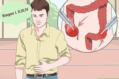 How to Treat Colon Cancer