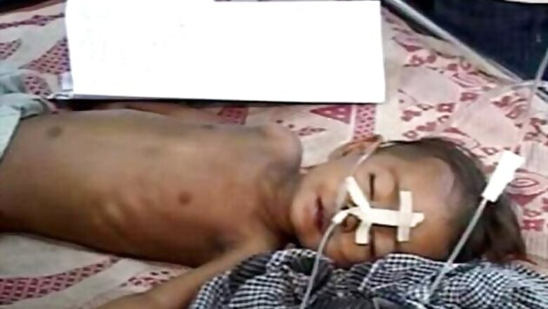Encephalitis claims 623 lives eastern UP this year
