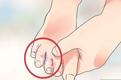 How to Know if You Have Athlete's Foot