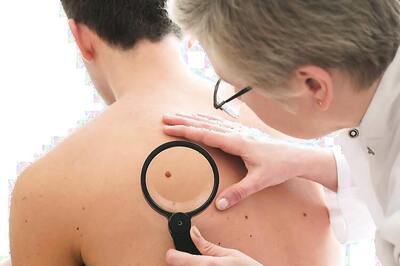 High BP Drug Could Treat Skin Cancer