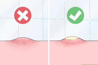 How to Painlessly Pop a Pimple