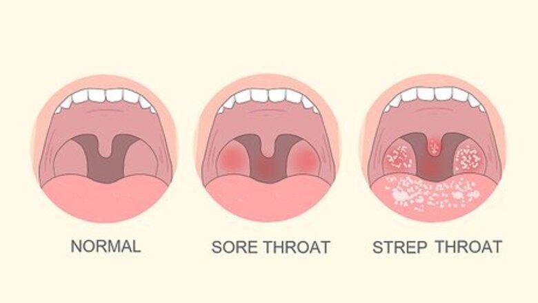How to Tell if You Have Strep Throat