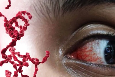 Summer Conjunctivitis: Types, Causes, Symptoms And Treatment