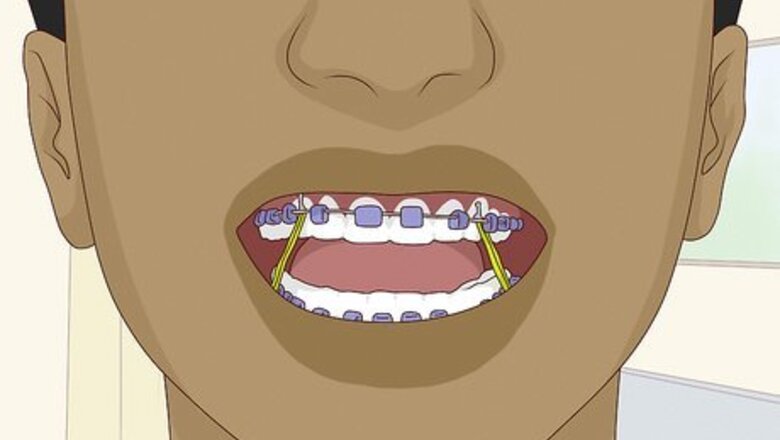 How to Wear Braces With Confidence and Style