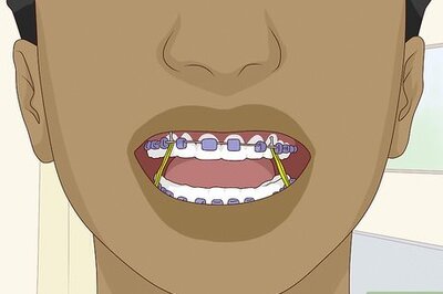 How to Wear Braces With Confidence and Style
