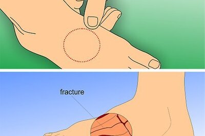How to Treat a Foot Stress Fracture