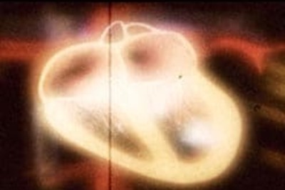 Gene variation, a cause for heart disease