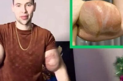 Russian Man Injects Six Litres Of Vaseline To Bulk Up His Biceps