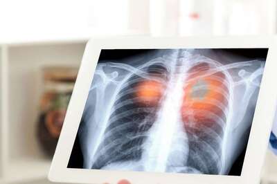 Why COVID-19 Pandemic Has Made Early Detection of Lung Cancer a Challenge