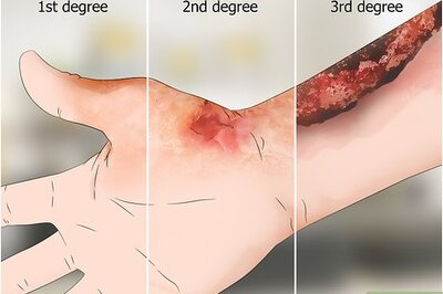 How to Heal Burns Fast