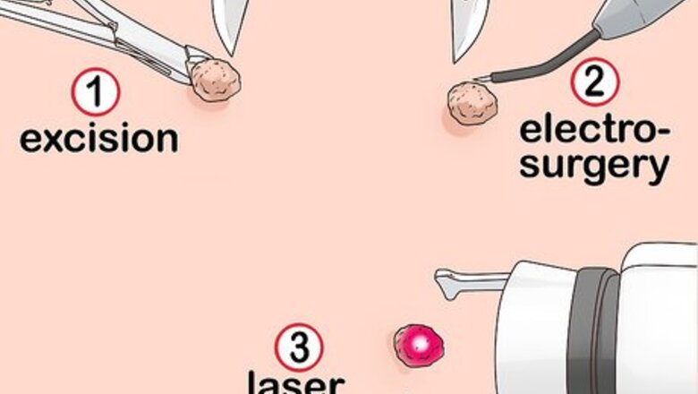 How to Get a Wart Surgically Removed