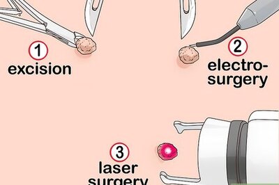 How to Get a Wart Surgically Removed